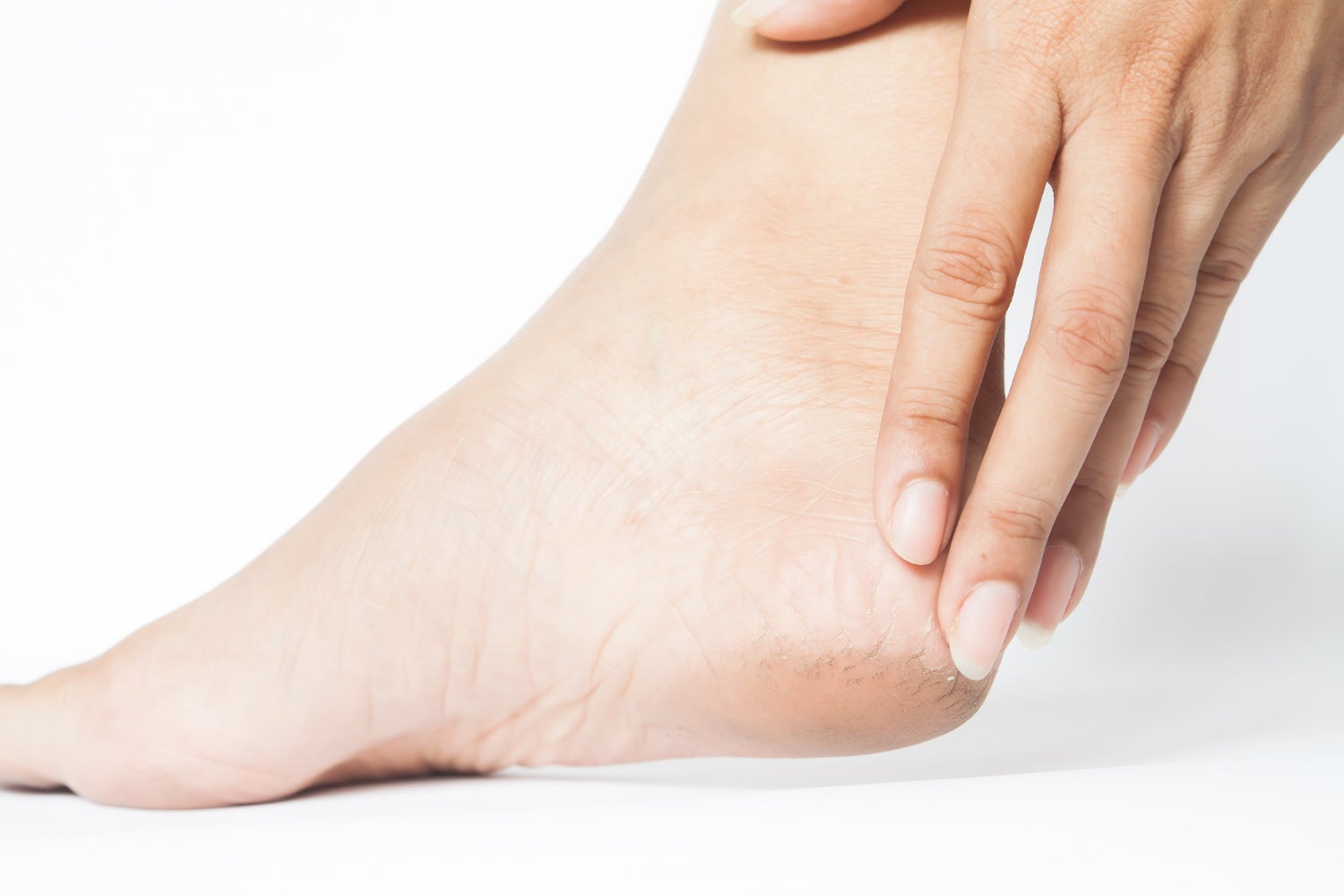 Corns and Calloused Heels | MobiCare Advanced Foot Care